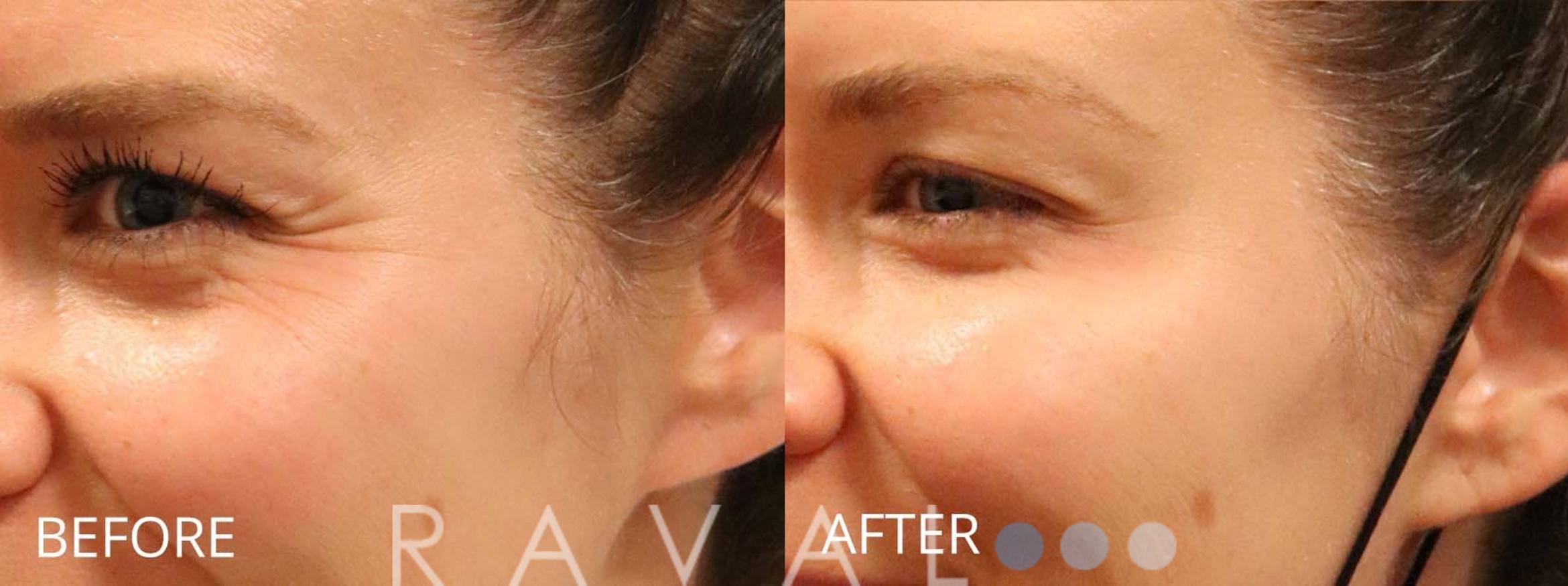 Before & After Botox & Dermal Fillers Case 1162 View 1 View in Denver, CO