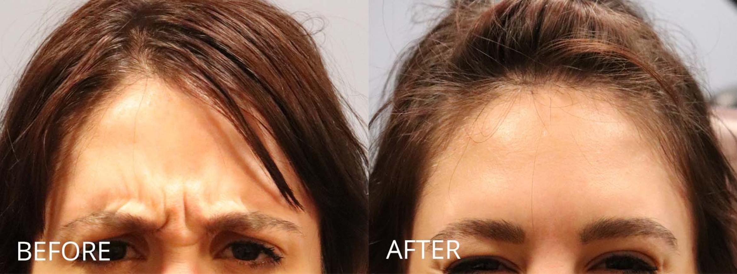 Before & After Botox & Dermal Fillers Case 1163 View 1 View in Denver, CO