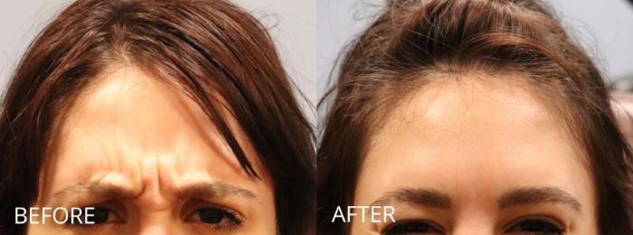 Before & After Botox & Dermal Fillers Case 1163 View 1 View in Denver, CO