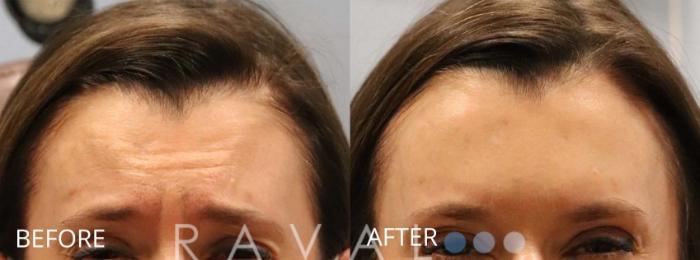 Before & After Botox & Dermal Fillers Case 1164 View 1 View in Denver, CO