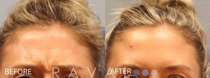 Before & After Botox & Dermal Fillers Case 1165 View 1 View in Denver, CO