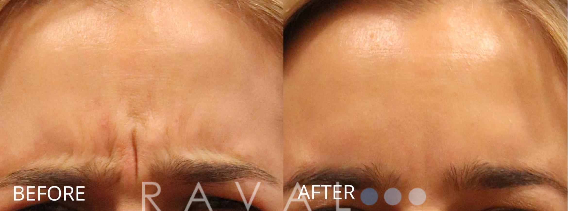Before & After Botox & Dermal Fillers Case 1166 View 1 View in Denver, CO