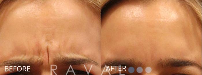 Before & After Botox & Dermal Fillers Case 1166 View 1 View in Denver, CO