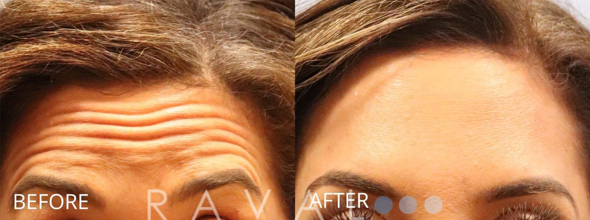 Before & After Botox & Dermal Fillers Case 1167 View 1 View in Denver, CO