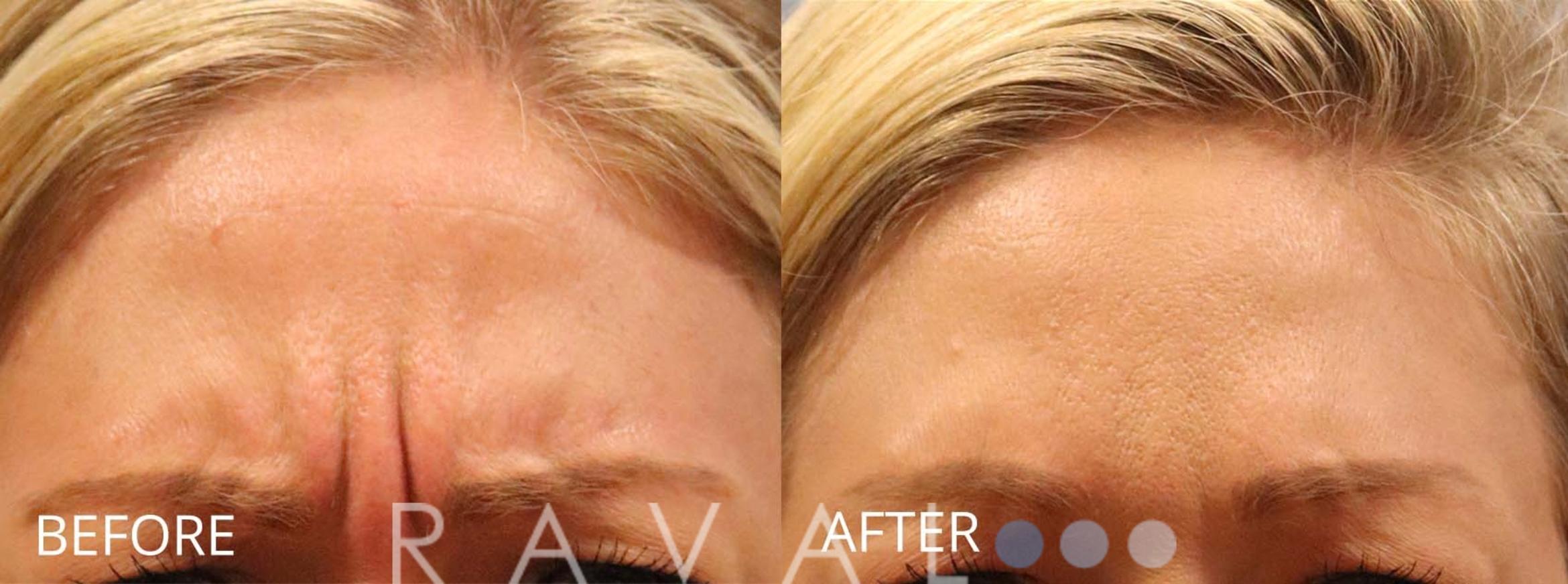 Before & After Botox & Dermal Fillers Case 1168 View 1 View in Denver, CO