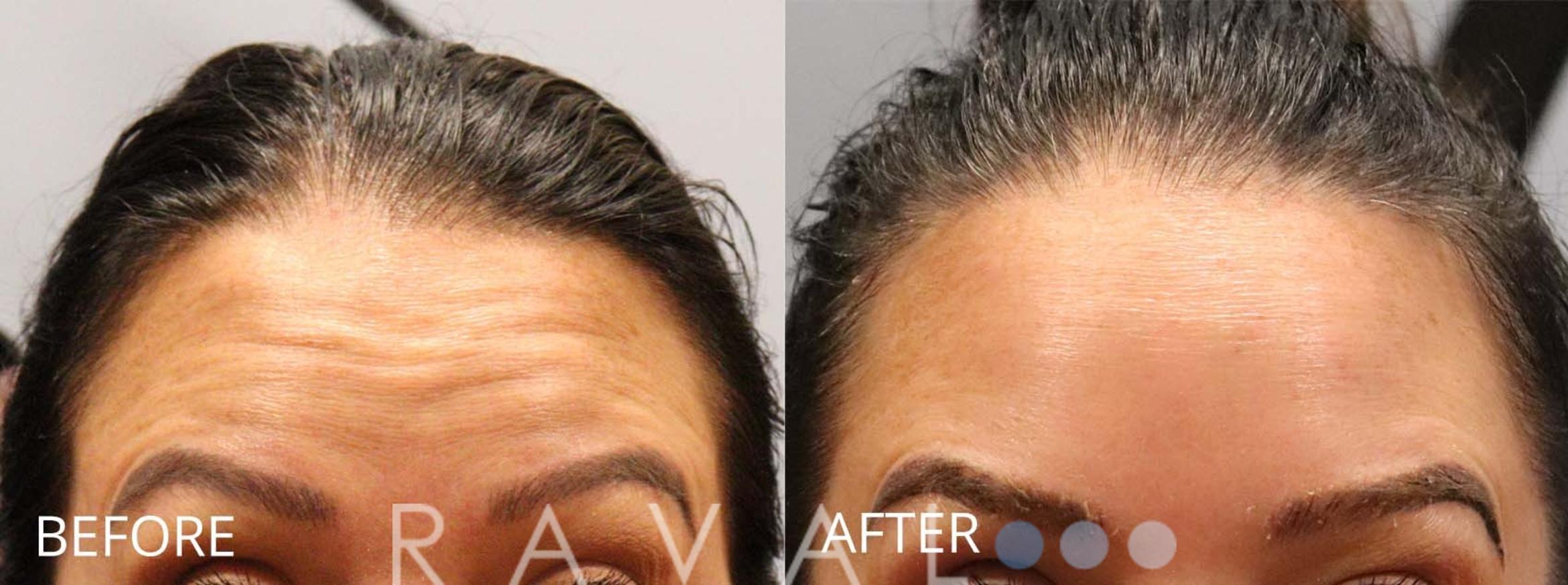 Before & After Botox & Dermal Fillers Case 1169 View 1 View in Denver, CO