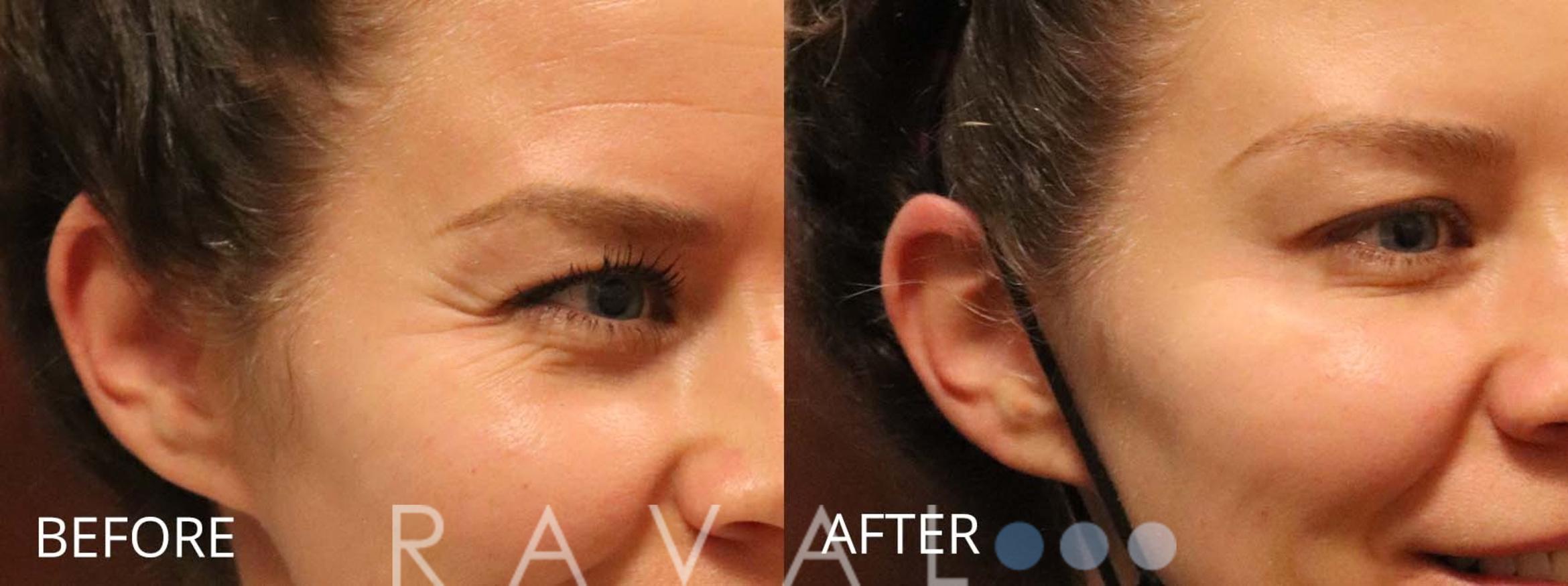 Before & After Botox & Dermal Fillers Case 1170 View 1 View in Denver, CO