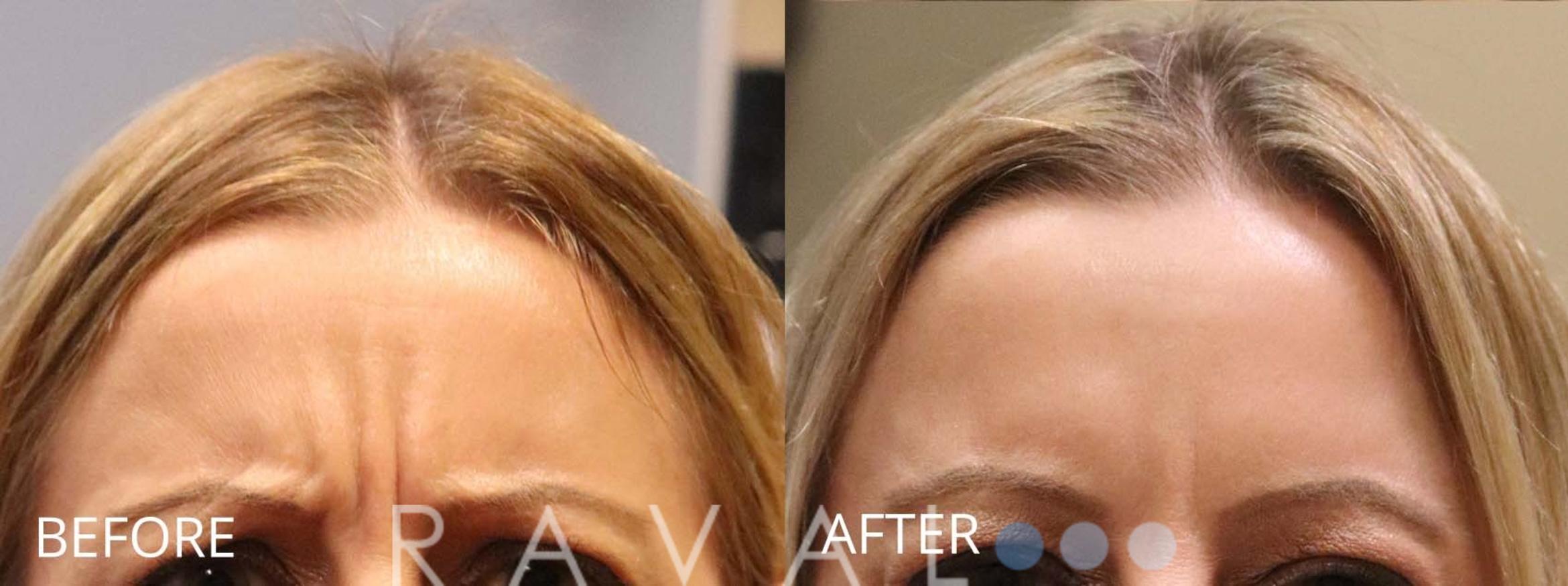 Before & After Botox & Dermal Fillers Case 1171 View 1 View in Denver, CO