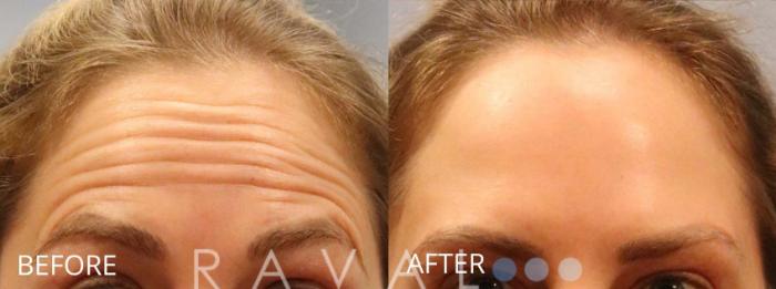 Before & After Botox & Dermal Fillers Case 1172 View 1 View in Denver, CO