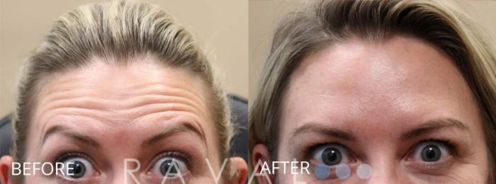 Before & After Botox & Dermal Fillers Case 1173 View 1 View in Denver, CO