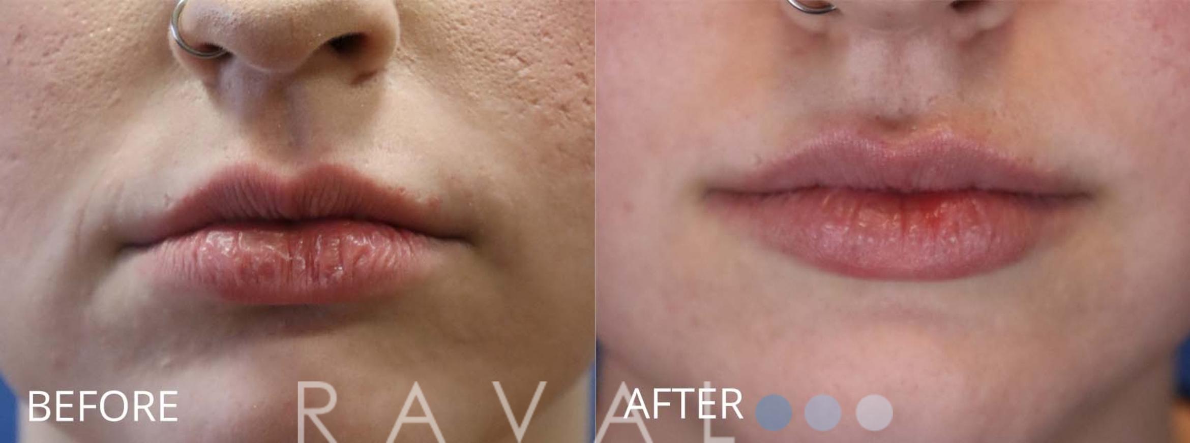 Before & After Botox & Dermal Fillers Case 1174 View 1 View in Denver, CO