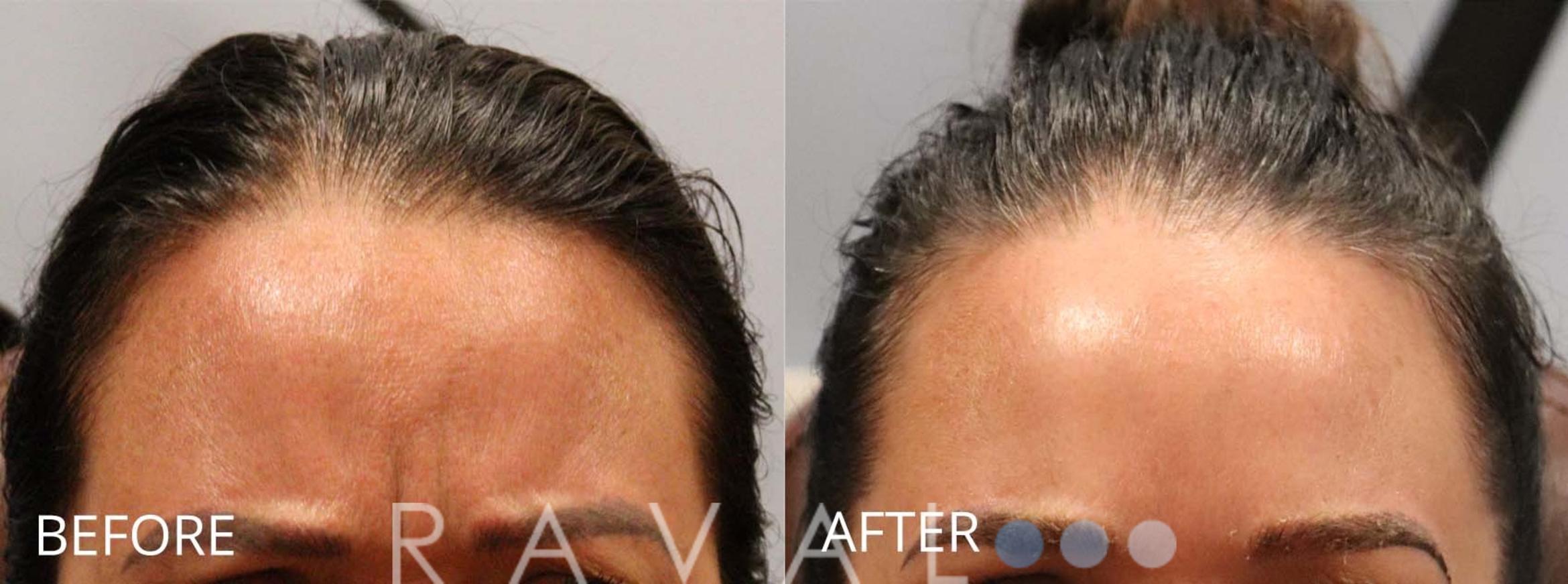 Before & After Botox & Dermal Fillers Case 1175 View 1 View in Denver, CO