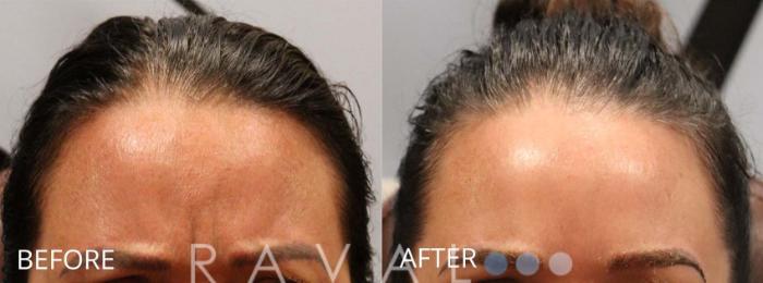 Before & After Botox & Dermal Fillers Case 1175 View 1 View in Denver, CO