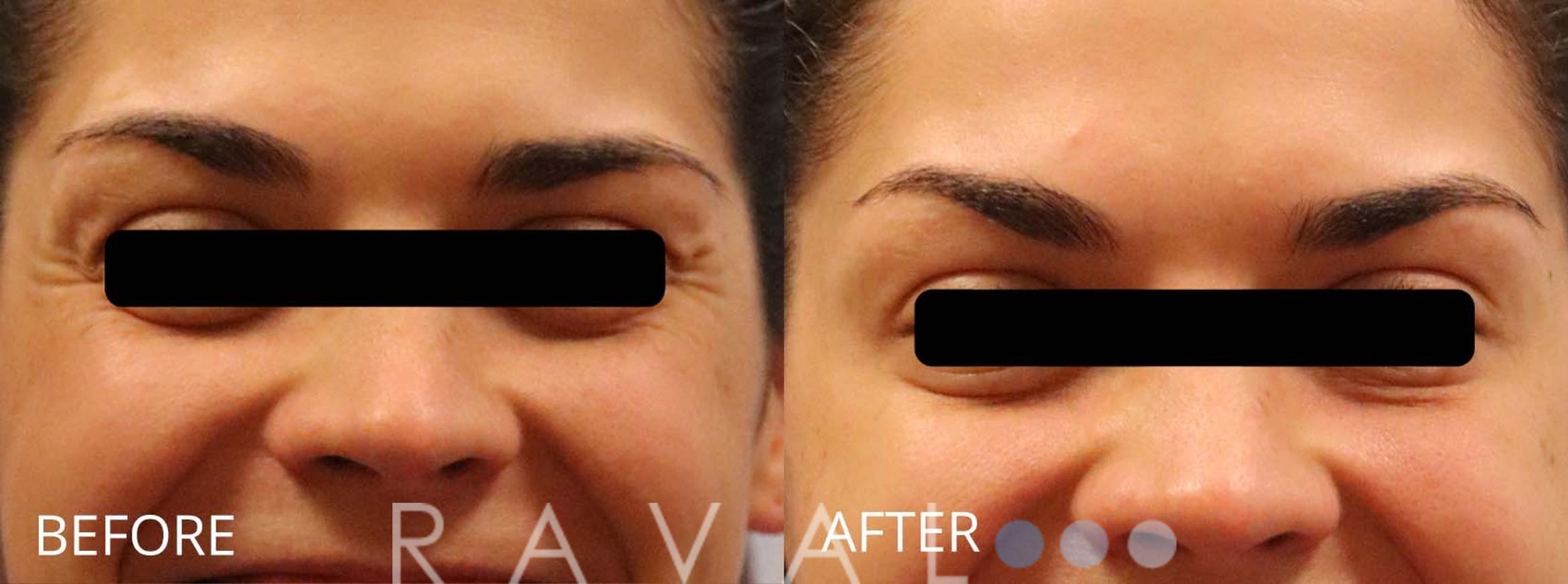 Before & After Botox & Dermal Fillers Case 1176 View 1 View in Denver, CO