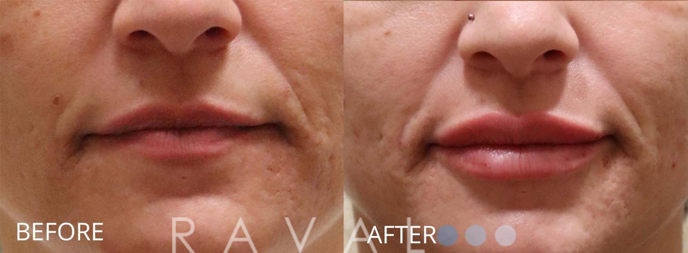 Before & After Botox & Dermal Fillers Case 1177 View 1 View in Denver, CO