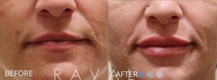 Before & After Botox & Dermal Fillers Case 1177 View 1 View in Denver, CO