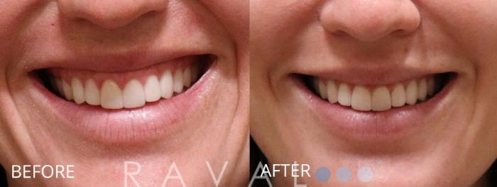 Before & After Botox & Dermal Fillers Case 1178 View 1 View in Denver, CO
