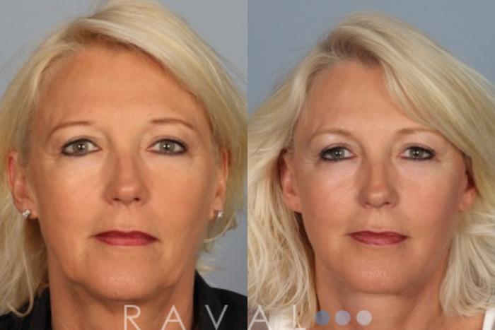 Before & After Botox & Dermal Fillers Case 1179 View 1 View in Denver, CO