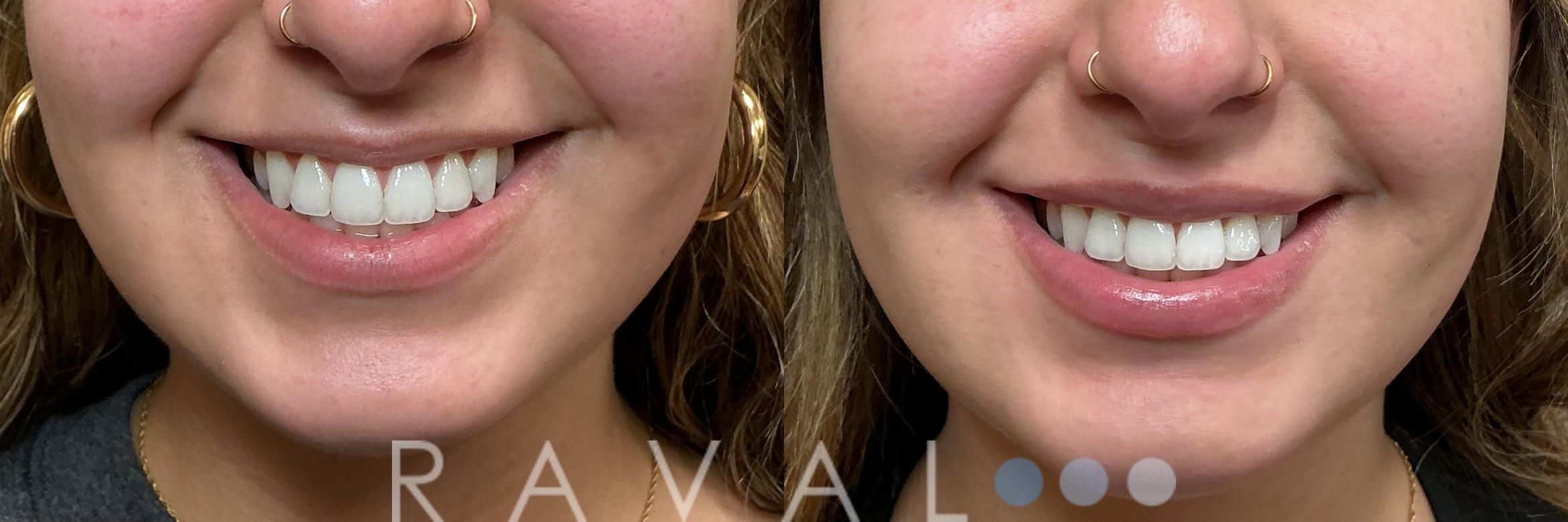 Before & After Botox & Dermal Fillers Case 1180 View 1 View in Denver, CO