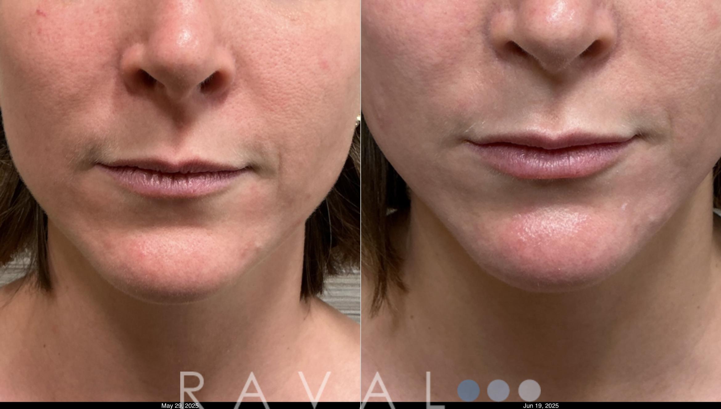 Before & After Botox & Dermal Fillers Case 1181 View 1 View in Denver, CO