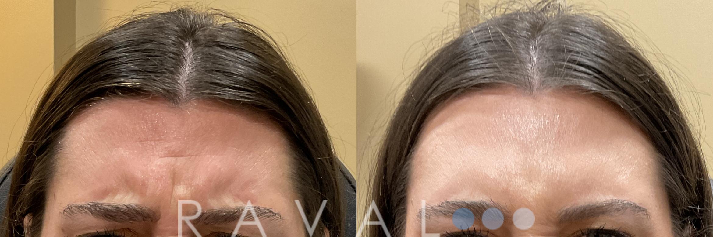 Before & After Botox & Dermal Fillers Case 1182 View 1 View in Denver, CO
