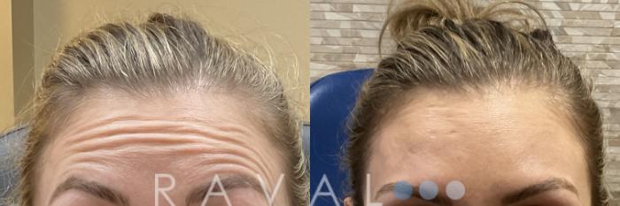 Before & After Botox & Dermal Fillers Case 1183 View 1 View in Denver, CO