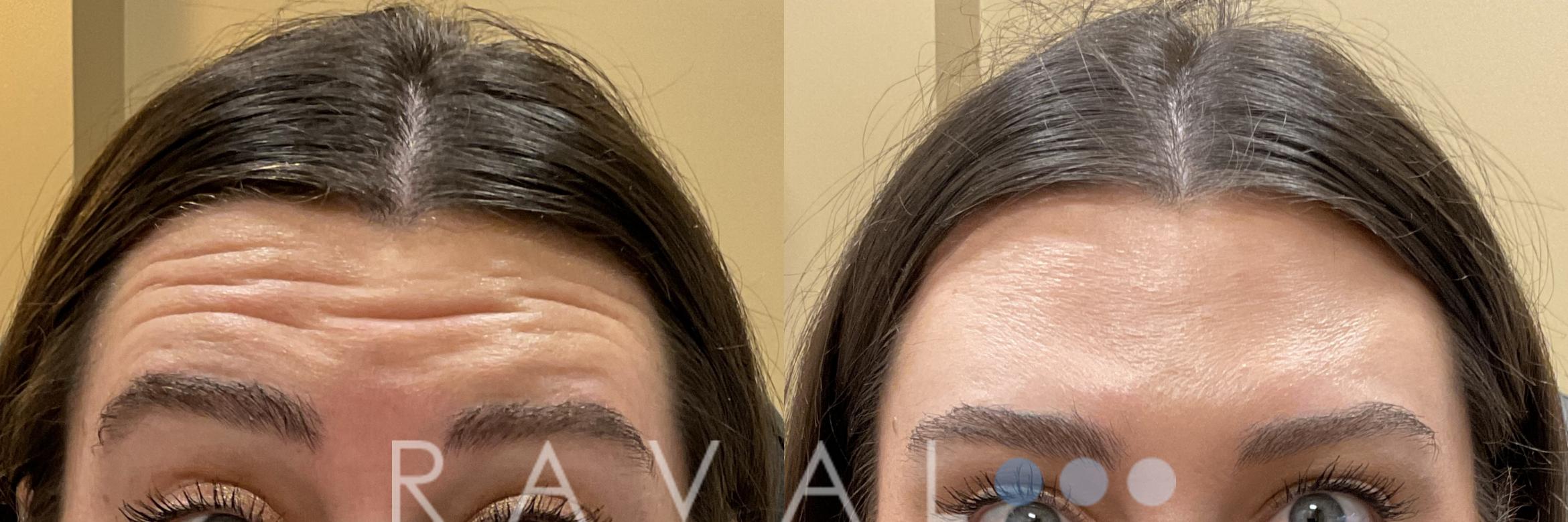 Before & After Botox & Dermal Fillers Case 1184 View 1 View in Denver, CO
