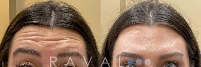 Before & After Botox & Dermal Fillers Case 1184 View 1 View in Denver, CO