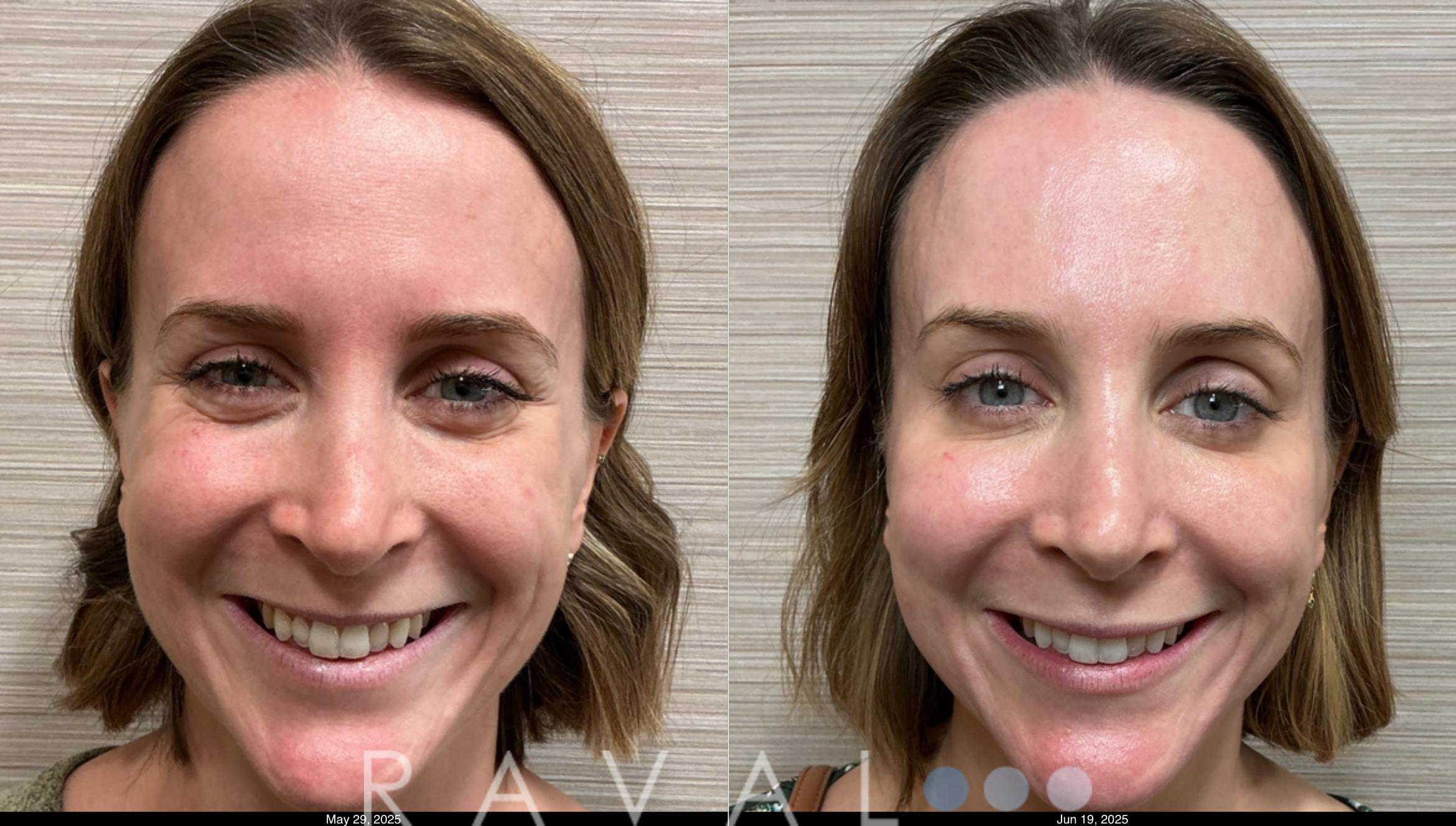 Before & After Botox & Dermal Fillers Case 1185 View 1 View in Denver, CO