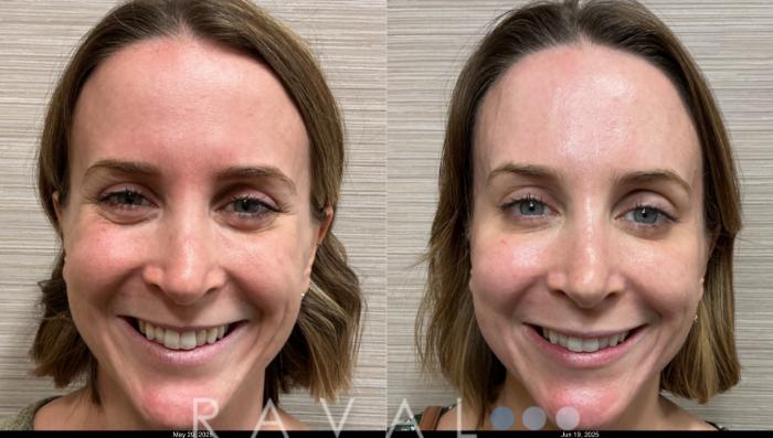 Before & After Botox & Dermal Fillers Case 1185 View 1 View in Denver, CO