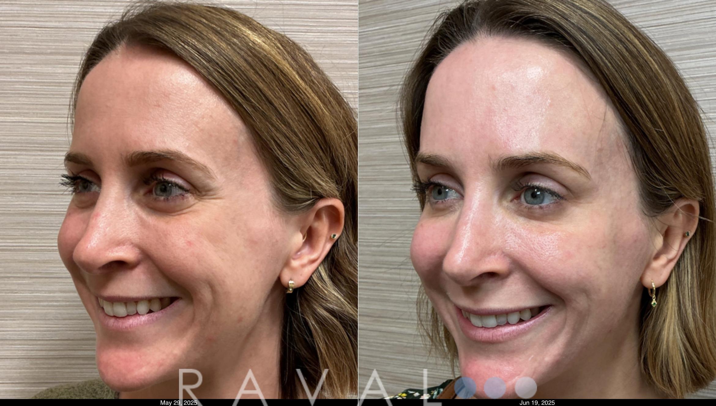Before & After Botox & Dermal Fillers Case 1185 View 2 View in Denver, CO