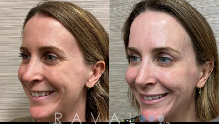 Before & After Botox & Dermal Fillers Case 1185 View 2 View in Denver, CO