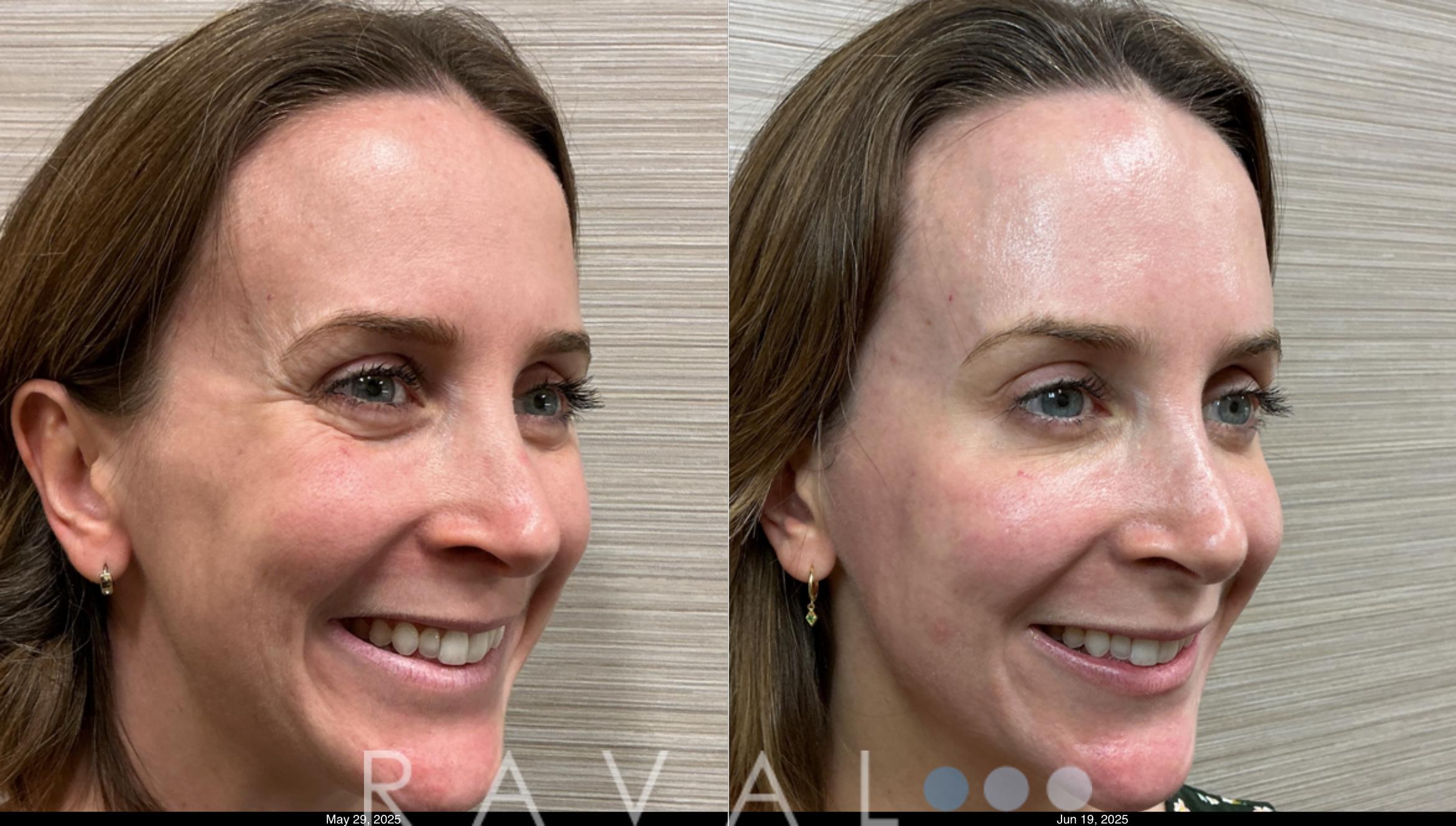 Before & After Botox & Dermal Fillers Case 1185 View 3 View in Denver, CO