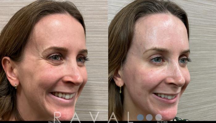 Before & After Botox & Dermal Fillers Case 1185 View 3 View in Denver, CO