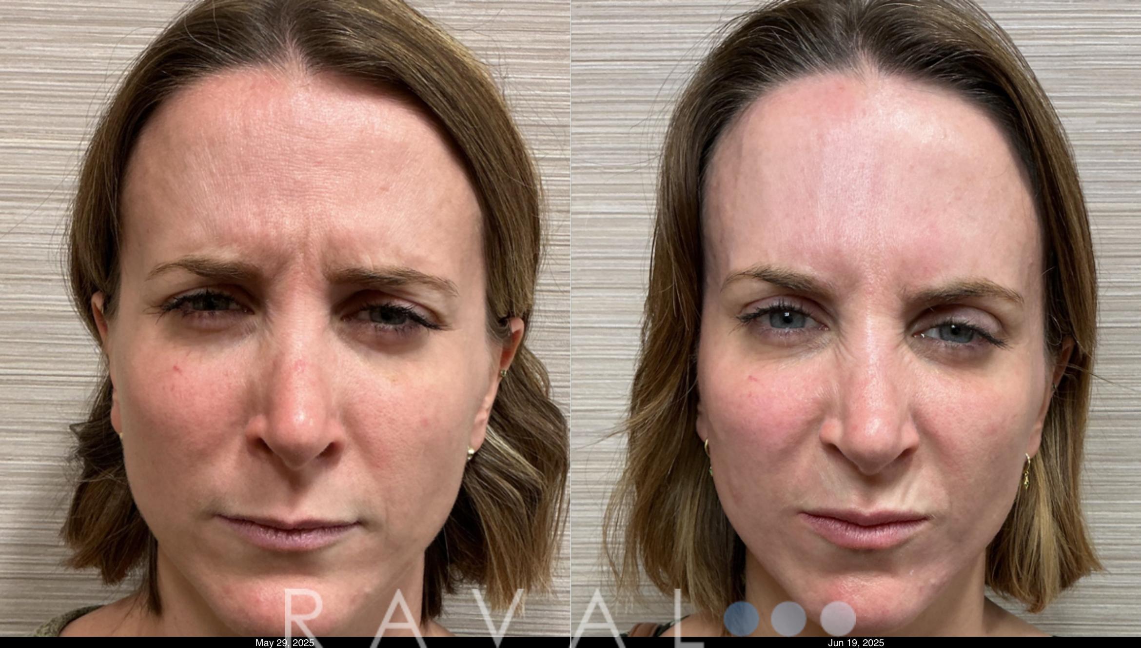 Before & After Botox & Dermal Fillers Case 1185 View 4 View in Denver, CO