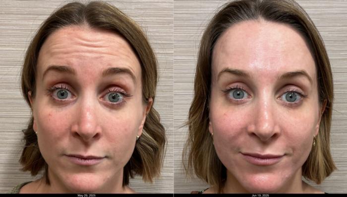 Before & After Botox & Dermal Fillers Case 1185 View 5 View in Denver, CO