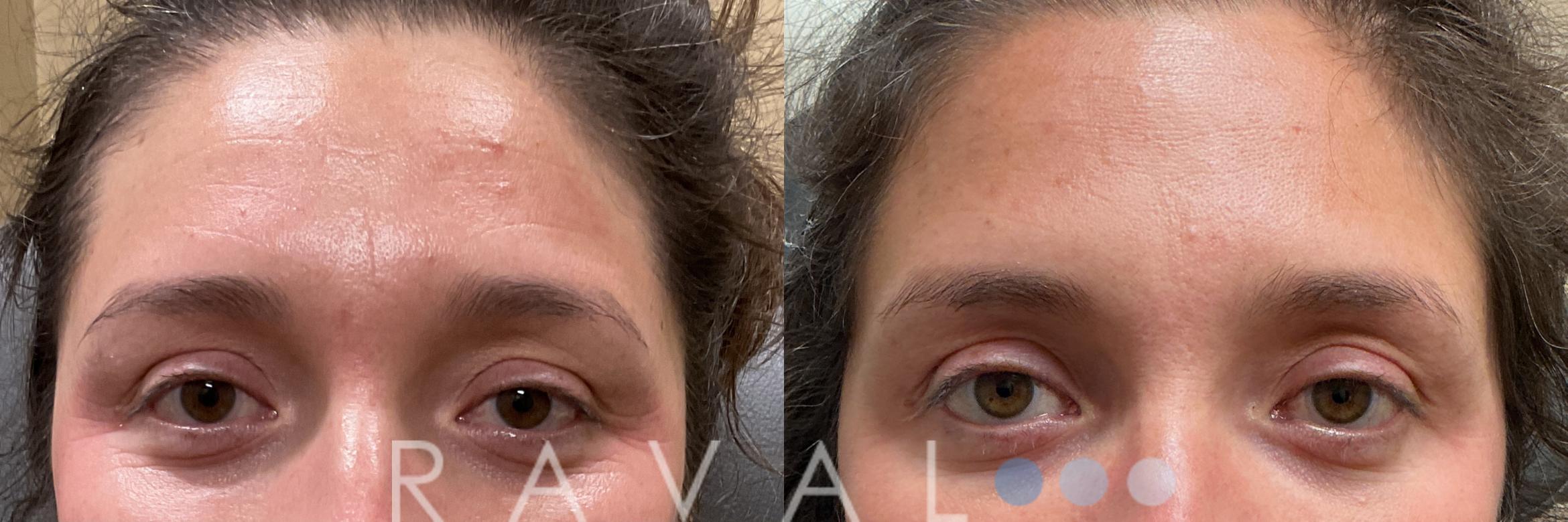 Before & After Botox & Dermal Fillers Case 1186 View 1 View in Denver, CO