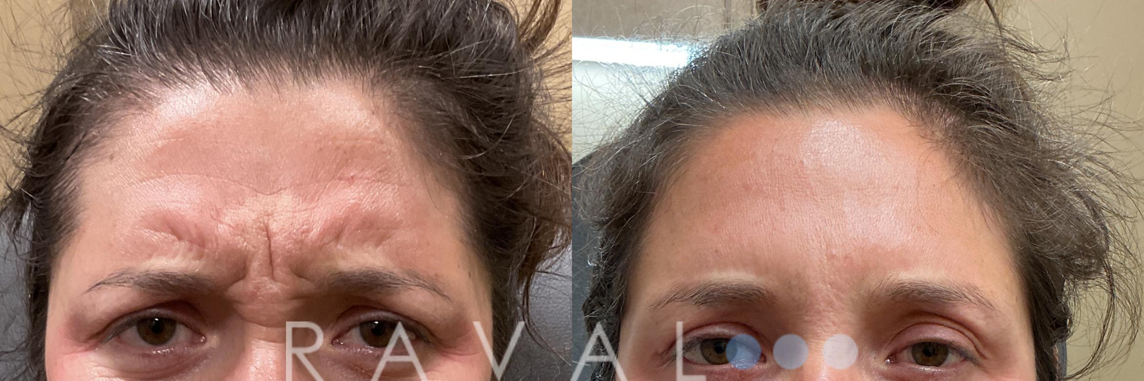 Before & After Botox & Dermal Fillers Case 1186 View 2 View in Denver, CO