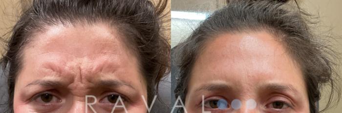 Before & After Botox & Dermal Fillers Case 1186 View 2 View in Denver, CO