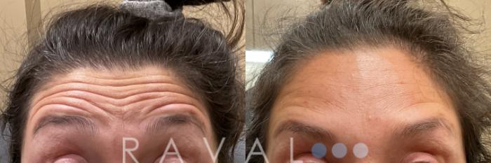 Before & After Botox & Dermal Fillers Case 1186 View 3 View in Denver, CO