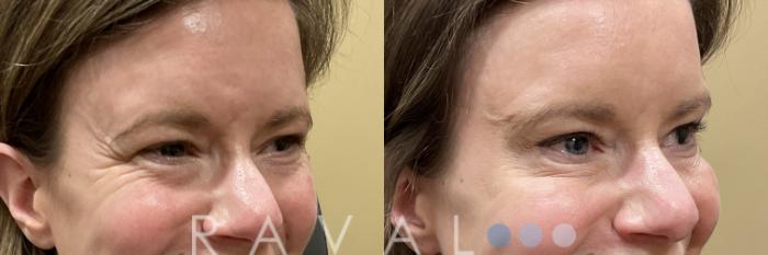 Before & After Botox & Dermal Fillers Case 1187 View 1 View in Denver, CO