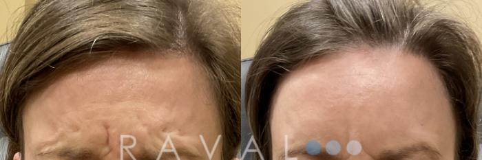 Before & After Botox & Dermal Fillers Case 1188 View 1 View in Denver, CO