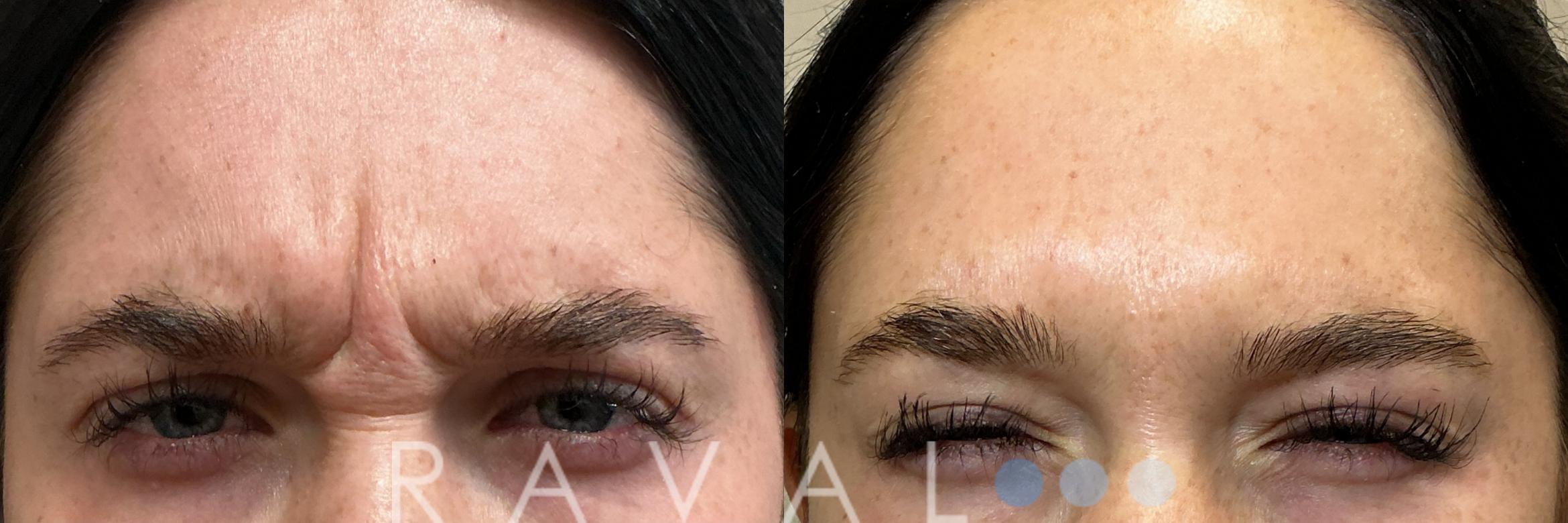 Before & After Botox & Dermal Fillers Case 1189 View 1 View in Denver, CO