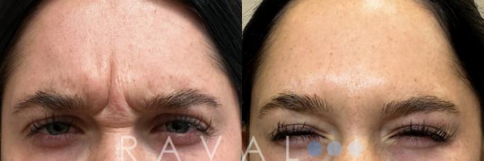 Before & After Botox & Dermal Fillers Case 1189 View 1 View in Denver, CO