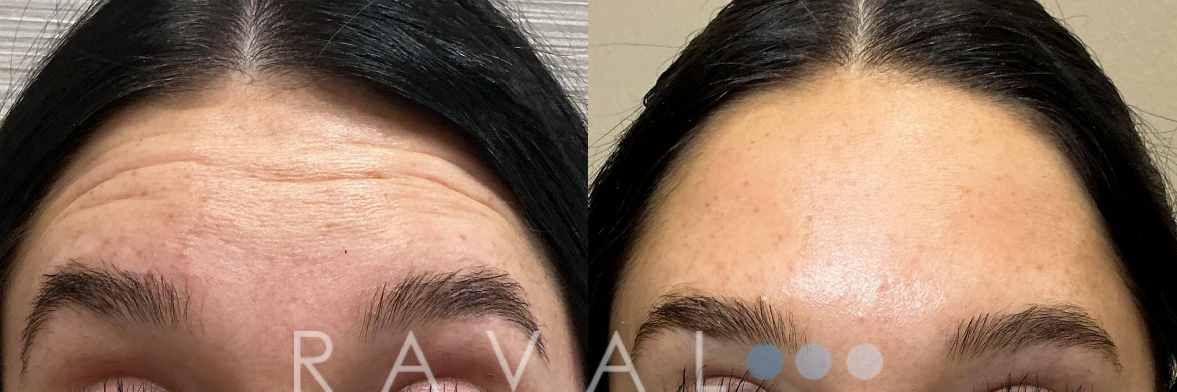 Before & After Botox & Dermal Fillers Case 1190 View 1 View in Denver, CO