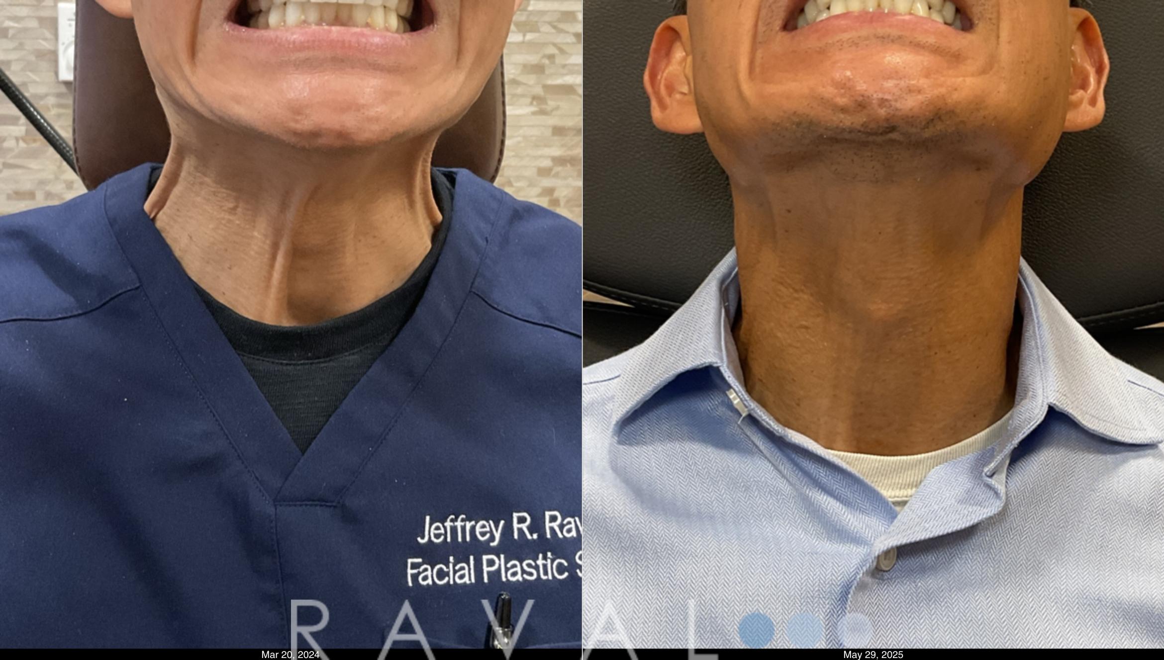 Before & After Botox & Dermal Fillers Case 1191 View 1 View in Denver, CO