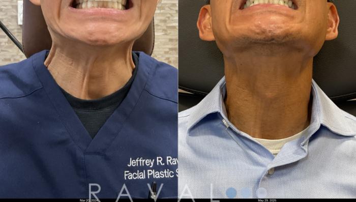 Before & After Botox & Dermal Fillers Case 1191 View 1 View in Denver, CO