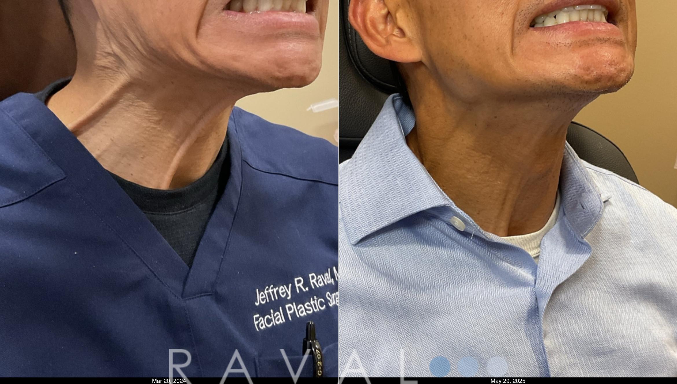 Before & After Botox & Dermal Fillers Case 1191 View 2 View in Denver, CO