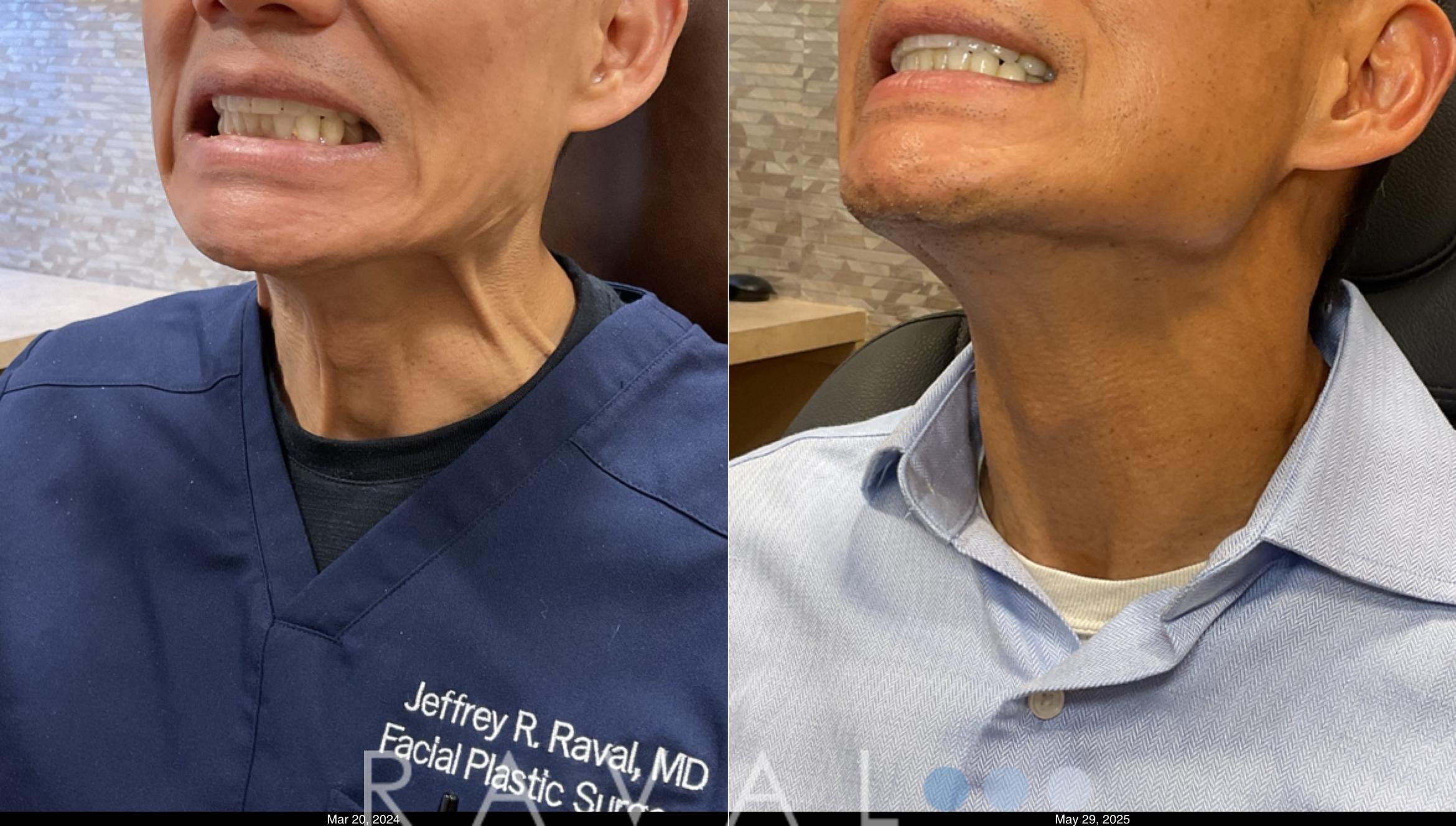 Before & After Botox & Dermal Fillers Case 1191 View 3 View in Denver, CO