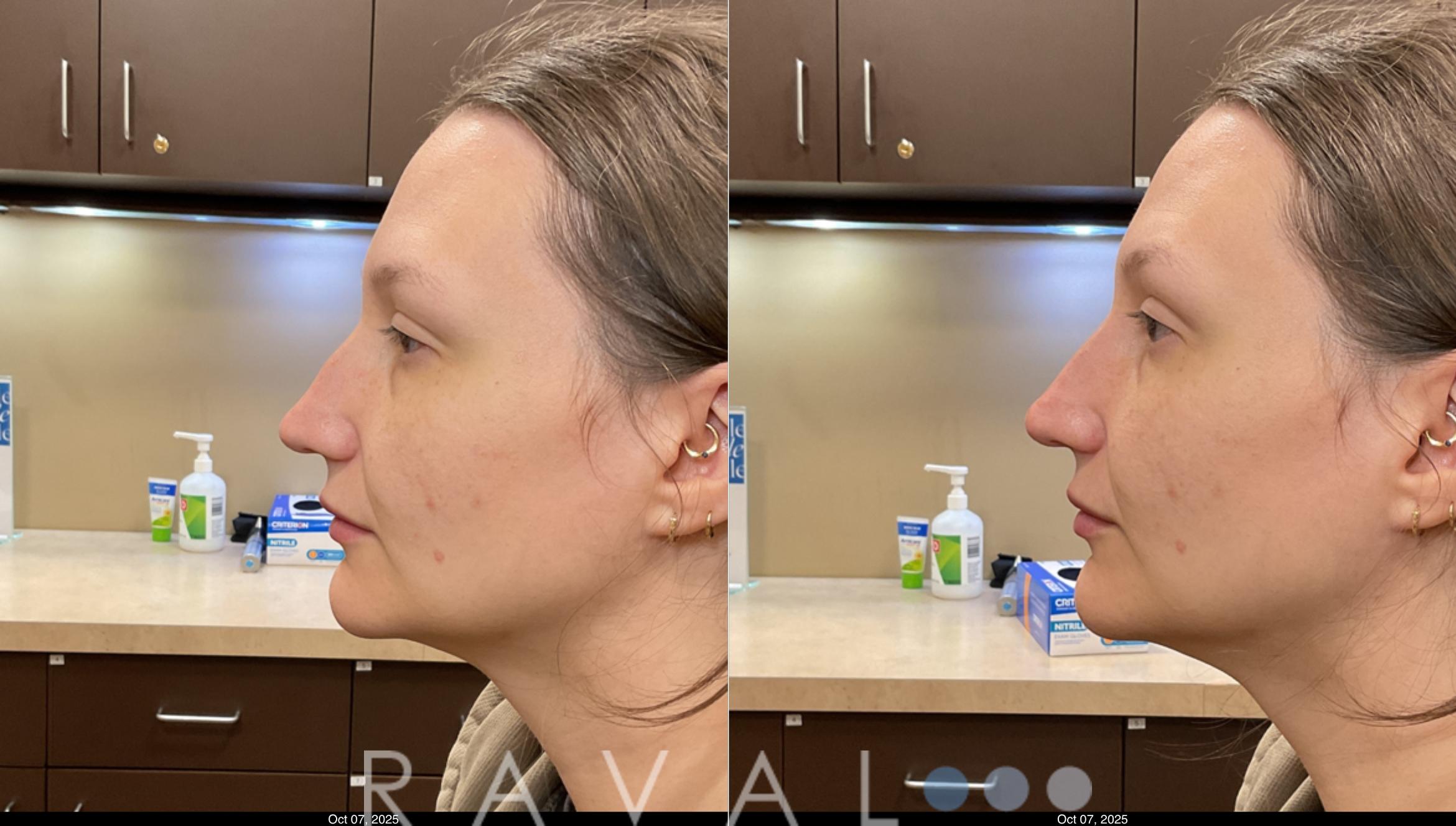 Before & After Botox & Dermal Fillers Case 1192 View 1 View in Denver, CO